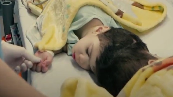 <span style="color: red;">ВИДЕО</span>: Успешно одвоени сијамски близнаци со помош на виртуелна реалност