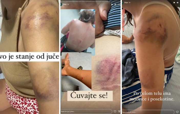 „Истепани, исечени и цели со модринки“: Граѓаните споделуваат фотографии од повредите настанати во невремето!