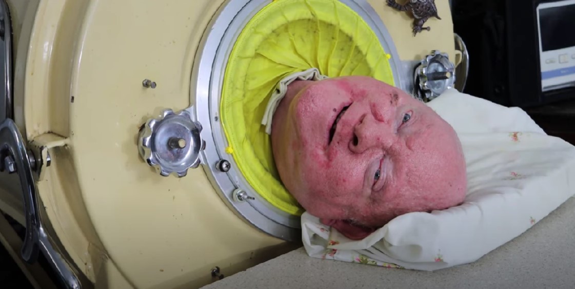 ВИДЕО Почина човекот кој повеќе од 70 години живееше со „железно белодробно крило“