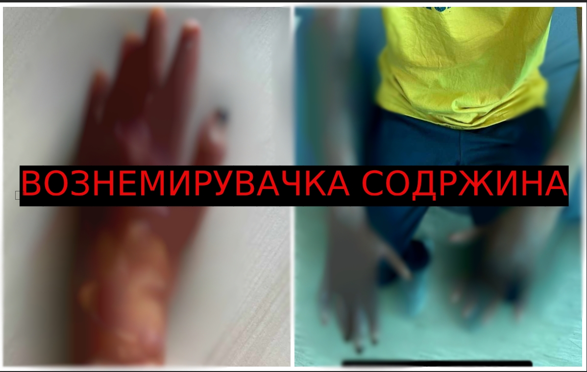 Support Kocani објави дел од изгореници на екстремитети кај младите за да надлежните сфатат колку се сериозни последиците